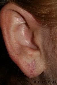 Earlobe Repair after 567482