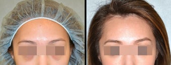 Lower Eyelid(Blepharoplasty) Surgery before 650659