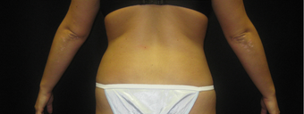 SmartLipo/MPX Flanks after 367551