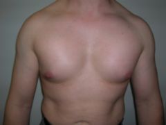 Pec Implants after 259002