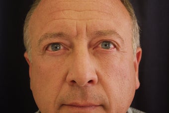 Blepharaoplasty after 343536