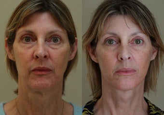 Neck Lift before 223554