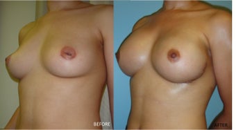 Breast reconstruction following bilateral mastectomy 416794
