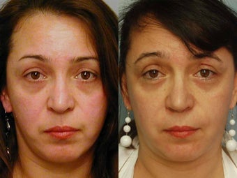 Two vials Sculptra before 125881