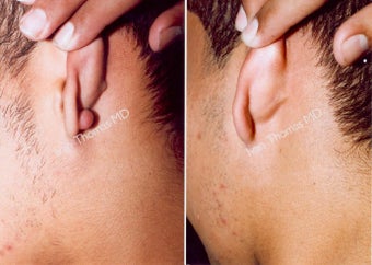 Earlobe Surgery before 243323