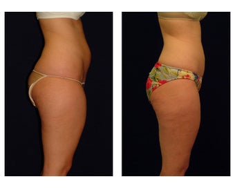 Liposuction before 286707
