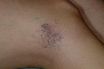 Sclerotherapy before 86808
