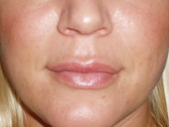 Lip Implants after 198656