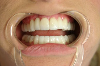smile make over after 466361