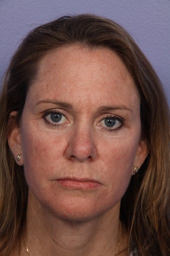 Neck Lift after 306406