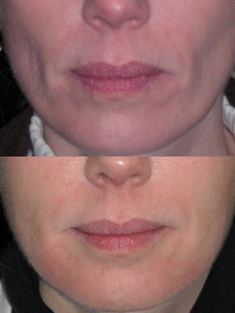 HA filler to the lower face before 406152