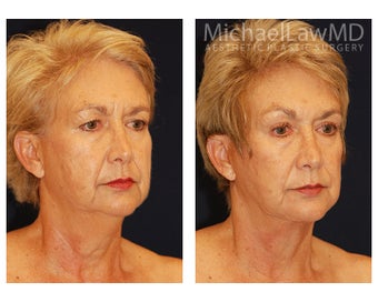 Facial Rejuvenation after 395177