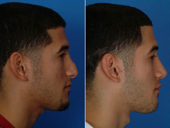 Nose Surgery (Revision Rhinoplasty) after 333096