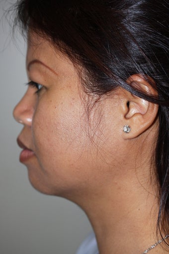 SmartLipo to the neck after 526866