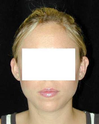 Otoplasty - Ear Surgery after 215191