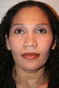African American Rhinoplasty before 448670