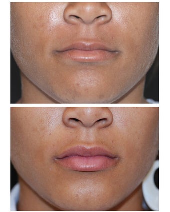 Restylane before 82768