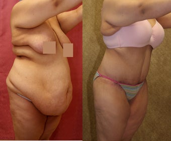 tummy tuck before 304693