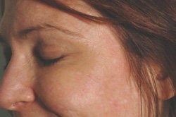 Botox for Crow's Feet after 91056