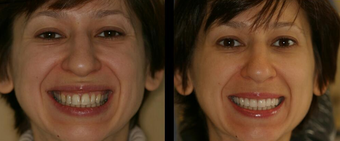 Smile Makeover with Veneers before 58931