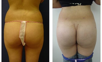 Buttocks Implants before 399986
