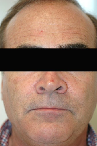 Dysport (Botox) for Forehead Wrinkles, Los Angeles, CA before 424745