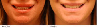 Lip Reduction before 245415