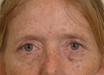 Pearl Laser Treatment before 102779