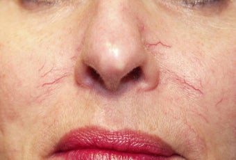 Vein treatment before 135899