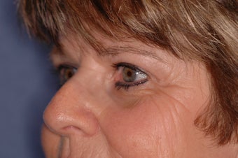 Pretrichial forehead lift and upper blepharoplasty 377313