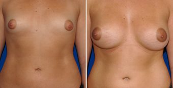 Breast Implants before 494496