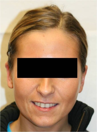 Otoplasty-Uniltaeral (right ear) after 109837