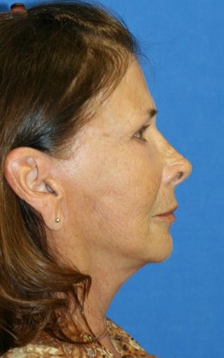 facelift after 264051