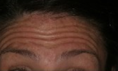 Botox before 317712