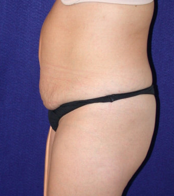 Tummy Tuck (abdominoplasty) 208480