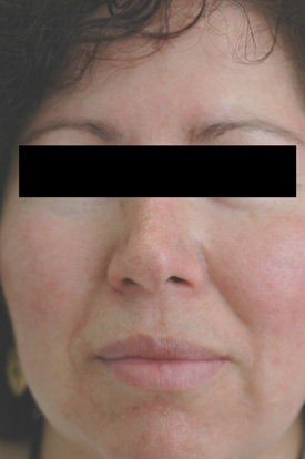 Laser Treatments for Rosacea after 106561