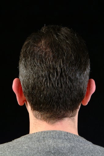 Ear Pinning 323699