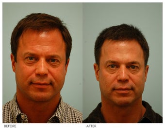 Botox before 138515