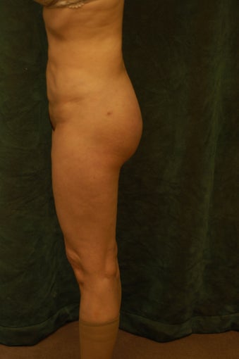 Women's Buttocks Augmentation after 518131