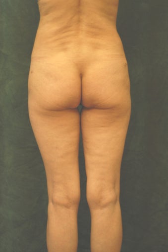Women's Buttocks Augmentation 518131