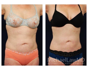 Liposuction after 629035