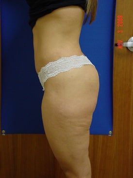 Brazilian Butt Lift/Liposuction 393405
