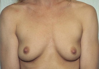 Breast Augmentation before 266794