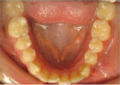 Invisalign 24 Months Severe Over Jet and Tongue Thrust 349090