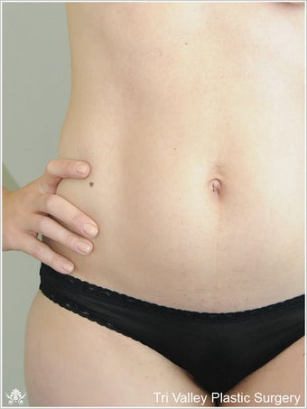 Liposuction before 420937