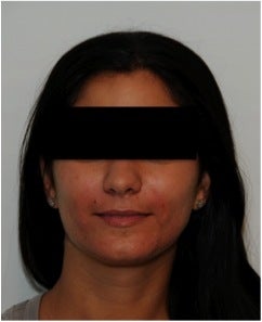 Evolence Injection in Smile Lines after 123626