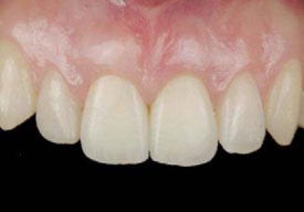 Dental Implants For Missing Front Teeth after 504315