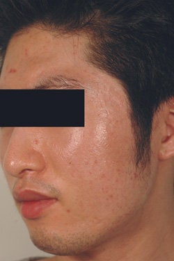 Laser Resurfacing after 89101