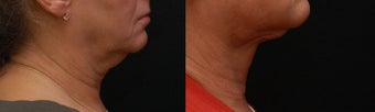 SmartLipo MPX neck & jowls before 367897