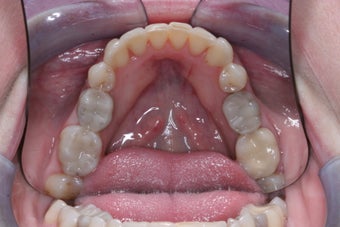 Mercury Silver filling replacment after 372796